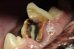abgestorbener Zahn mit Karies