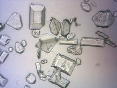 Struvitkristalle in einer Harnprobe